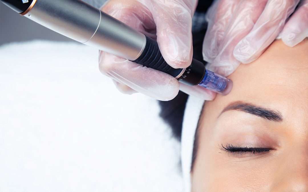 Microneedling 30% Discount