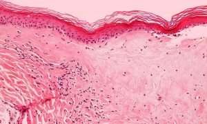 Lichen Sclerosus 16 silvery blue womens health clinic Lichen Sclerosus UTI